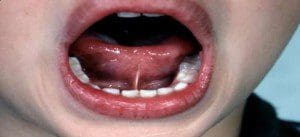 tonguetied2