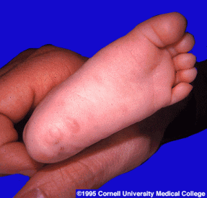 congenitalsyphilisearly