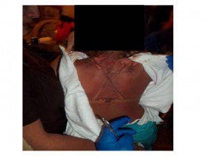 Photo of burns on 6-year-old child