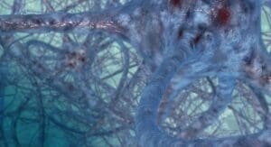 Parkinson's disease 